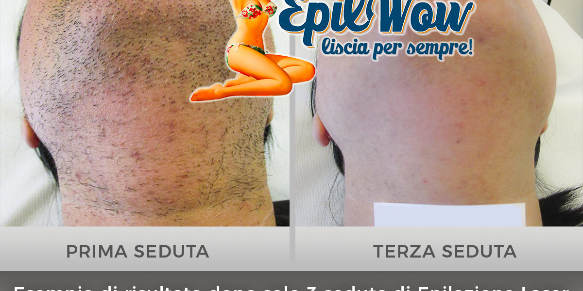 epilazione laser esperienze