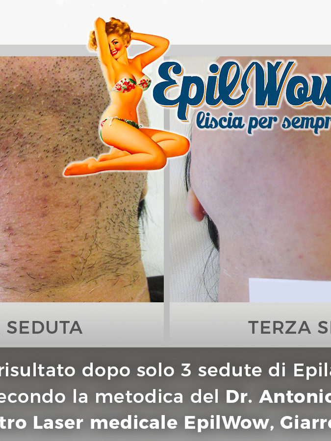 Epilazione Laser per irsutismo donna a Catania