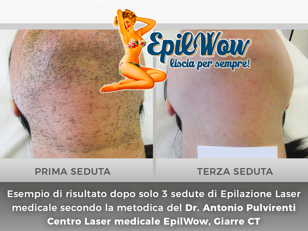 Epilazione Laser per irsutismo donna a Catania