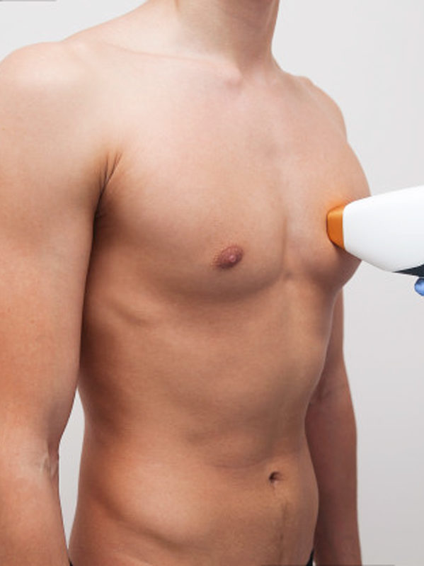 Epilazione Laser uomo, torace addome, Catania, Giarre, Provincia di Catania