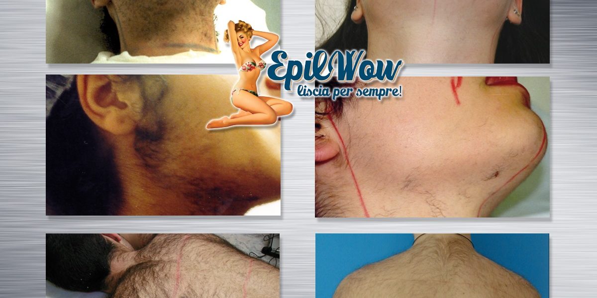 Irsutismo come risolverlo con l'epilazone Lase medicale Epilwow Giarre, Catania