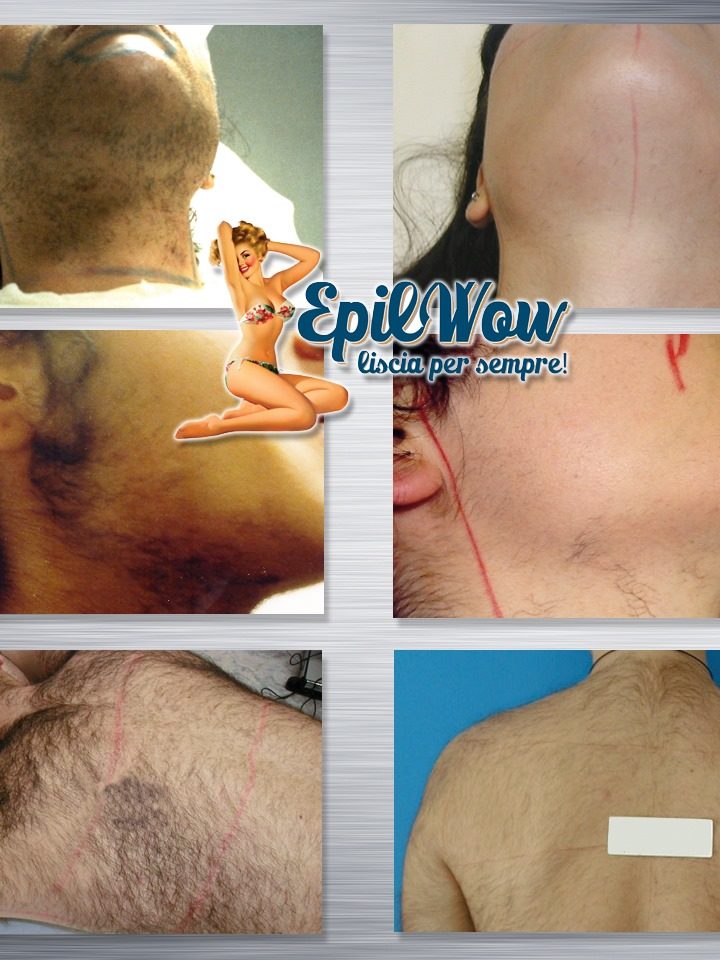 Irsutismo come risolverlo con l'epilazone Lase medicale Epilwow Giarre, Catania