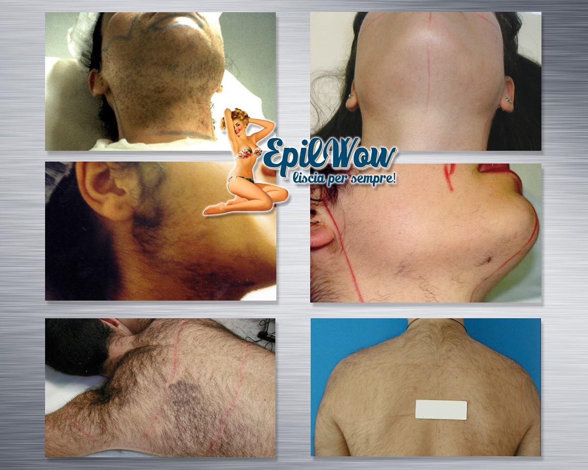 Irsutismo come risolverlo con l'epilazone Lase medicale Epilwow Giarre, Catania