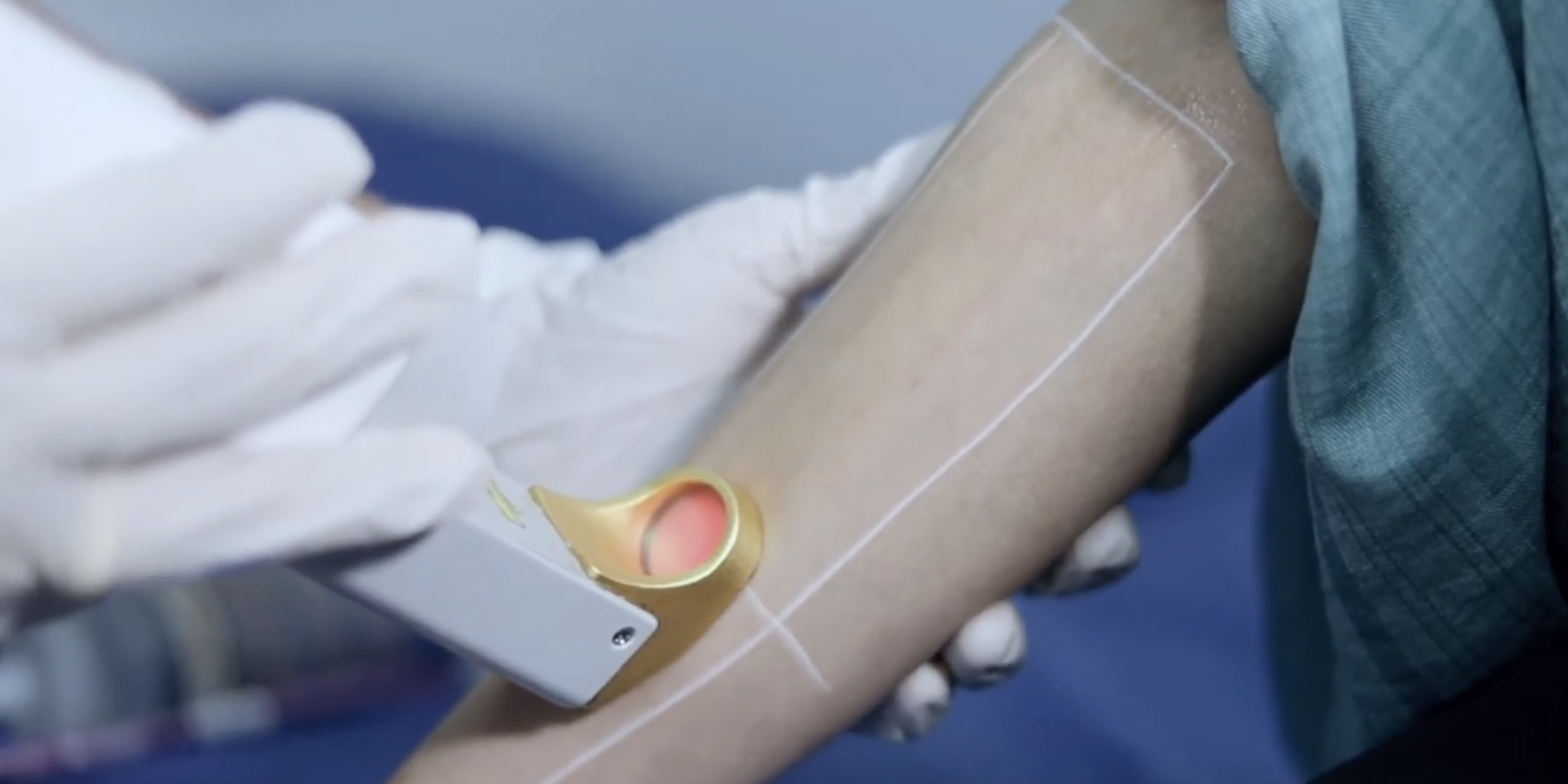 Epilazione Laser a Catania e Giarre Fototermolisi selettiva