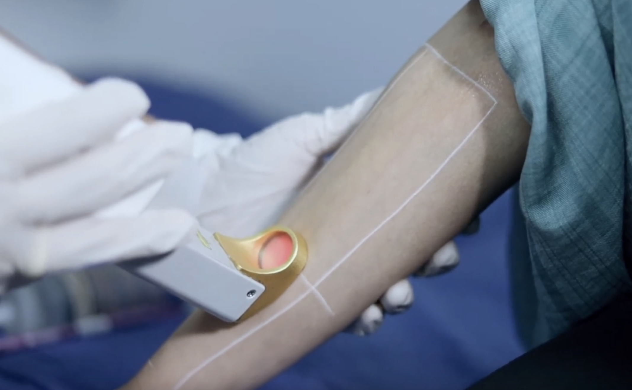 Epilazione Laser a Catania e Giarre Fototermolisi selettiva